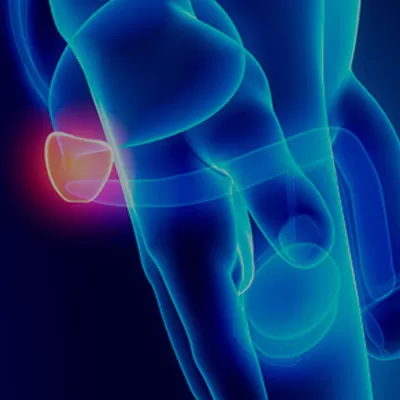 Vasectomia não aumenta o risco de câncer de próstata